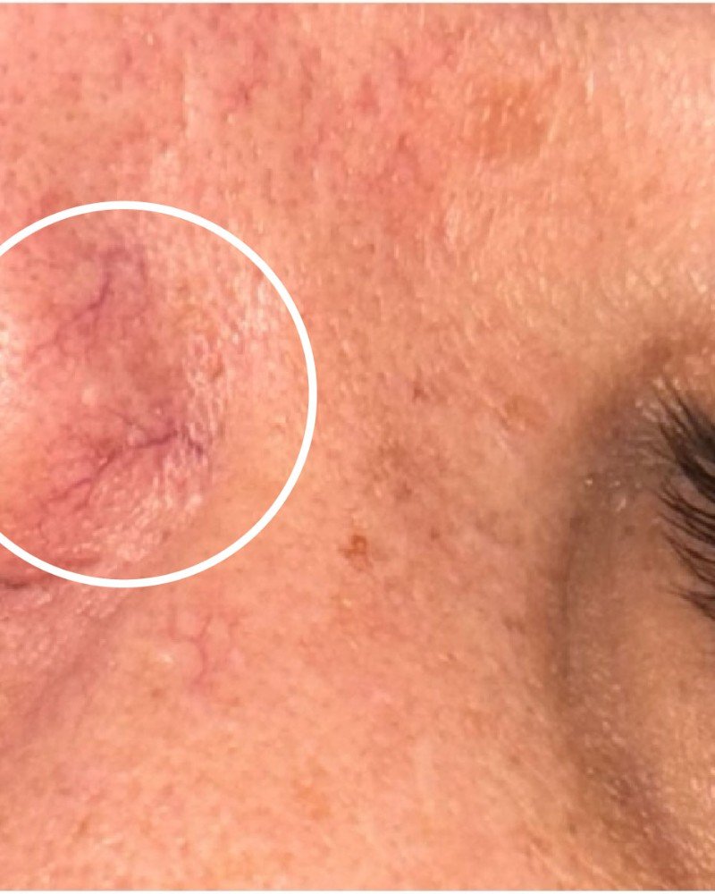 Uklanjanje kapilara na nosu — pre i posle laserskog tretmana